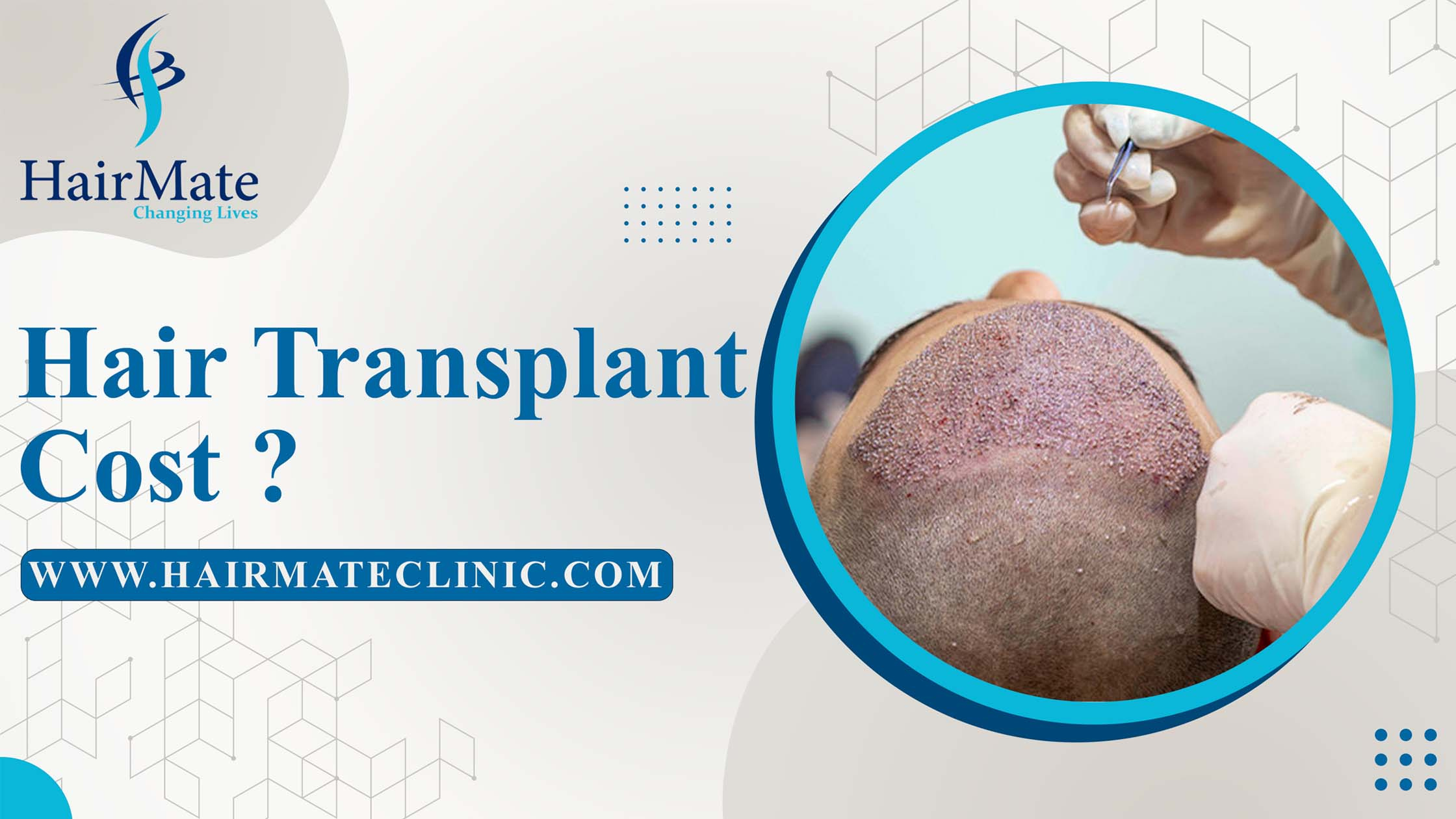 Hairmate | Hair Transplant Cost | About Hair Transplant Cost of hairmate  Clinic