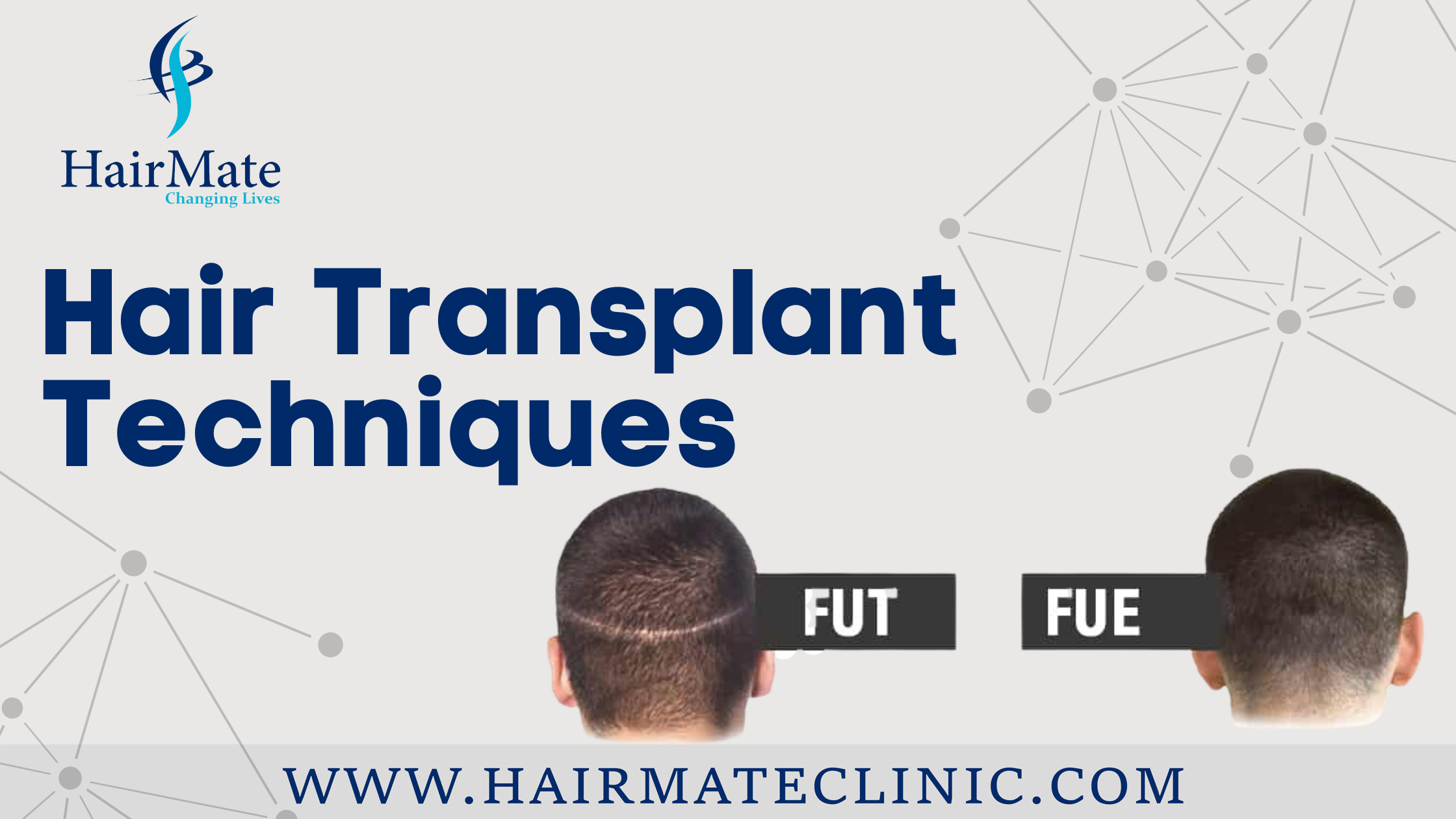 Different types of Hair Transplant Techniques - Hairmate Blog