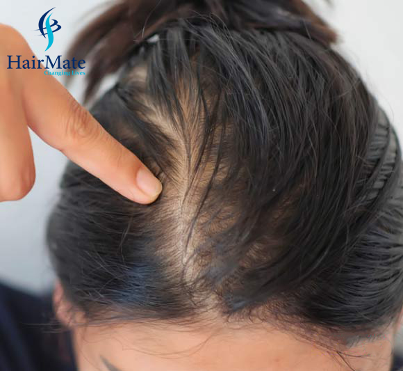 Hairmate Clinic || Hair Thinning Treatment || Hairmate clinic delhi