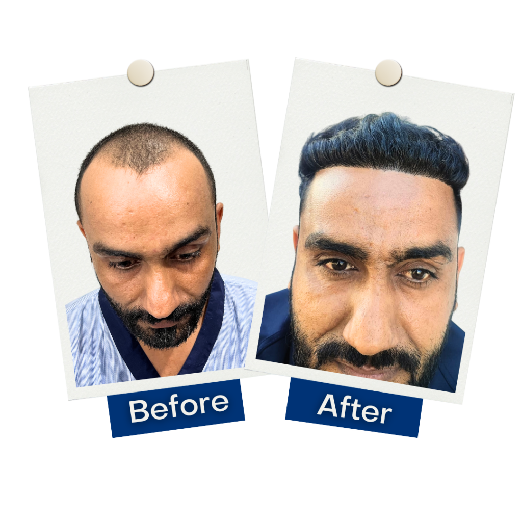 Hair Mate Clinic Hair Transplant Clinic Hair Transplantation at