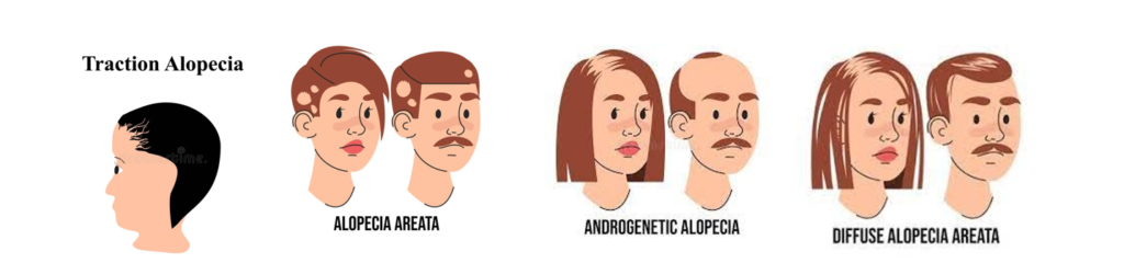 Types Of Hair Loss