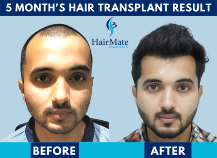 Hairmate clinic - Hair Transplant Clinic | Hair mate clinic || Hairmate  Delhi