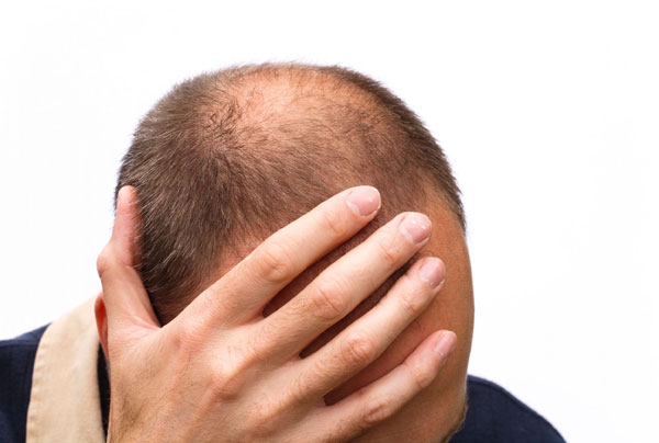 Man-with-thinning-hair-with-hand-on-head-5996535_l2