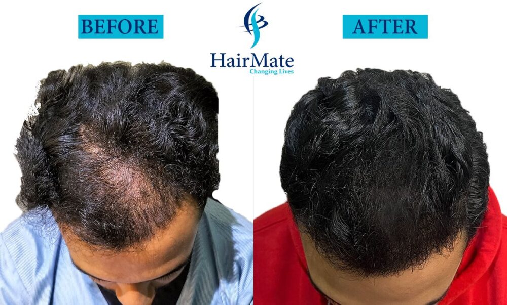 Hair Transplant in Delhi - Hairmate Clinic Delhi || Best hair ...