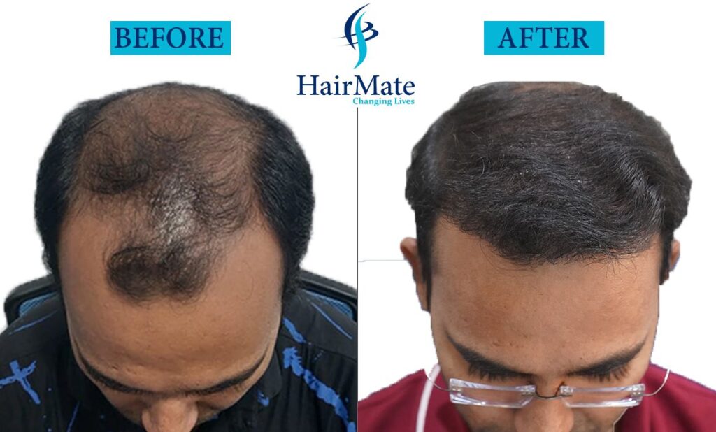 Hair Transplant in Pune - Hairmateclinic