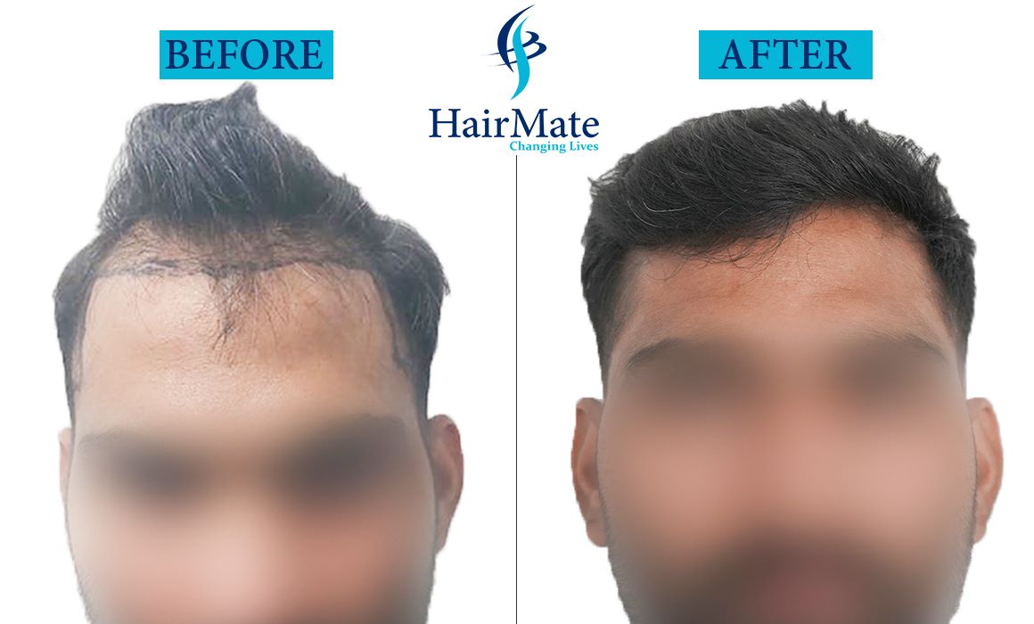 Hair Transplant in Pune Hairmate Hair Transplant Clinic in Pune