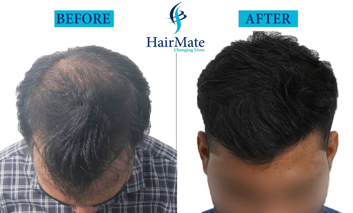 Hair Transplant in Pune || Hairmate - Hair Transplant Clinic in Pune