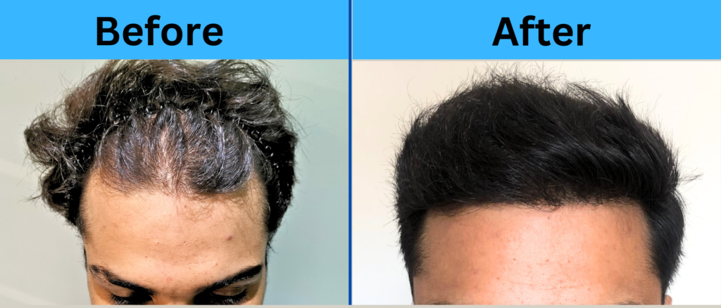 A Natural Hair Transplant Result By HairMate - Hairmateclinic