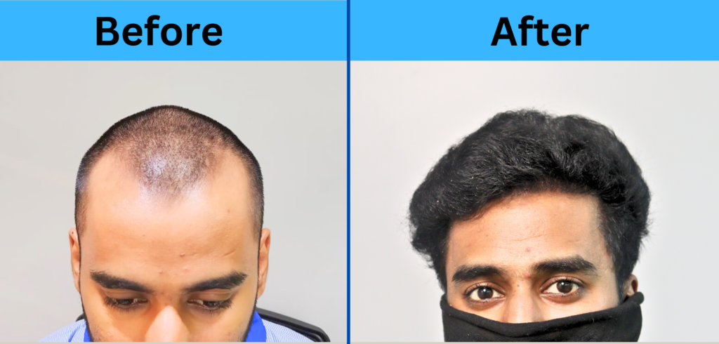 A Natural Hair Transplant Result By HairMate - Hairmateclinic