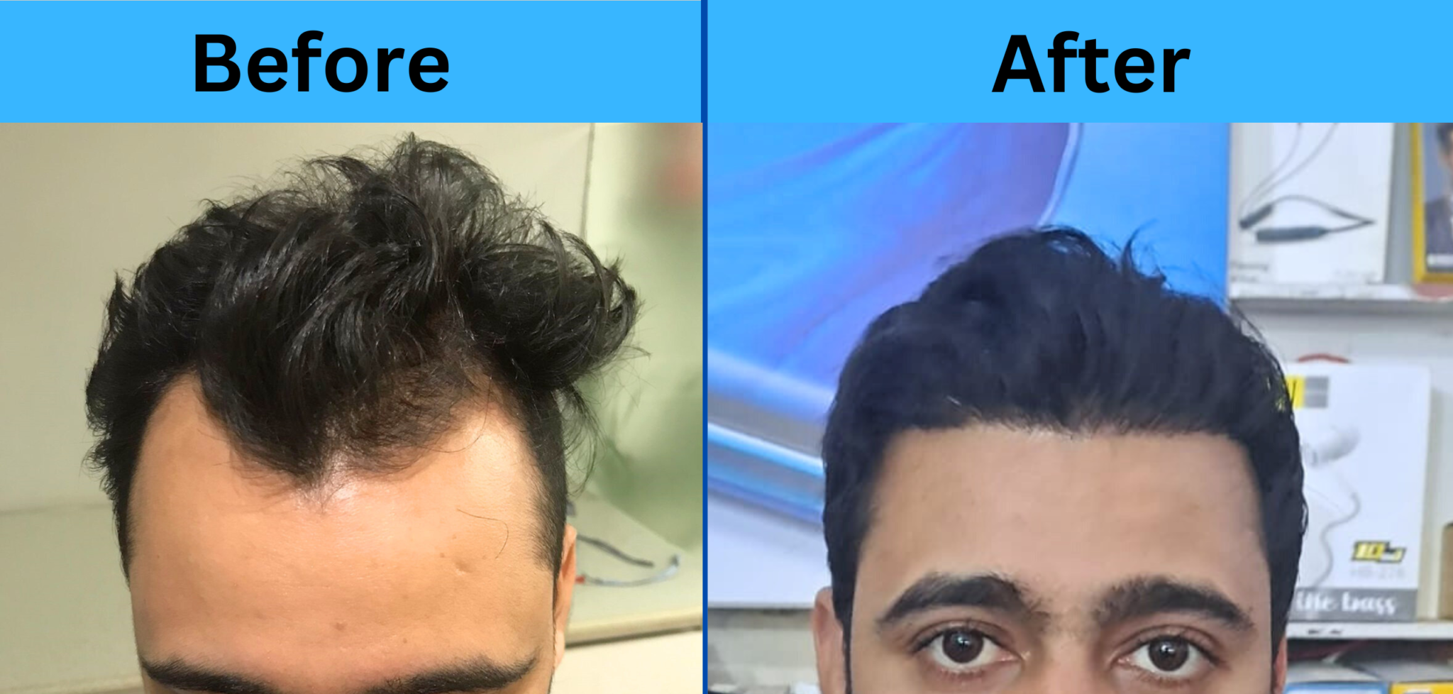 hair-mate-clinic-hair-transplant-clinic-hair-transplantation-at