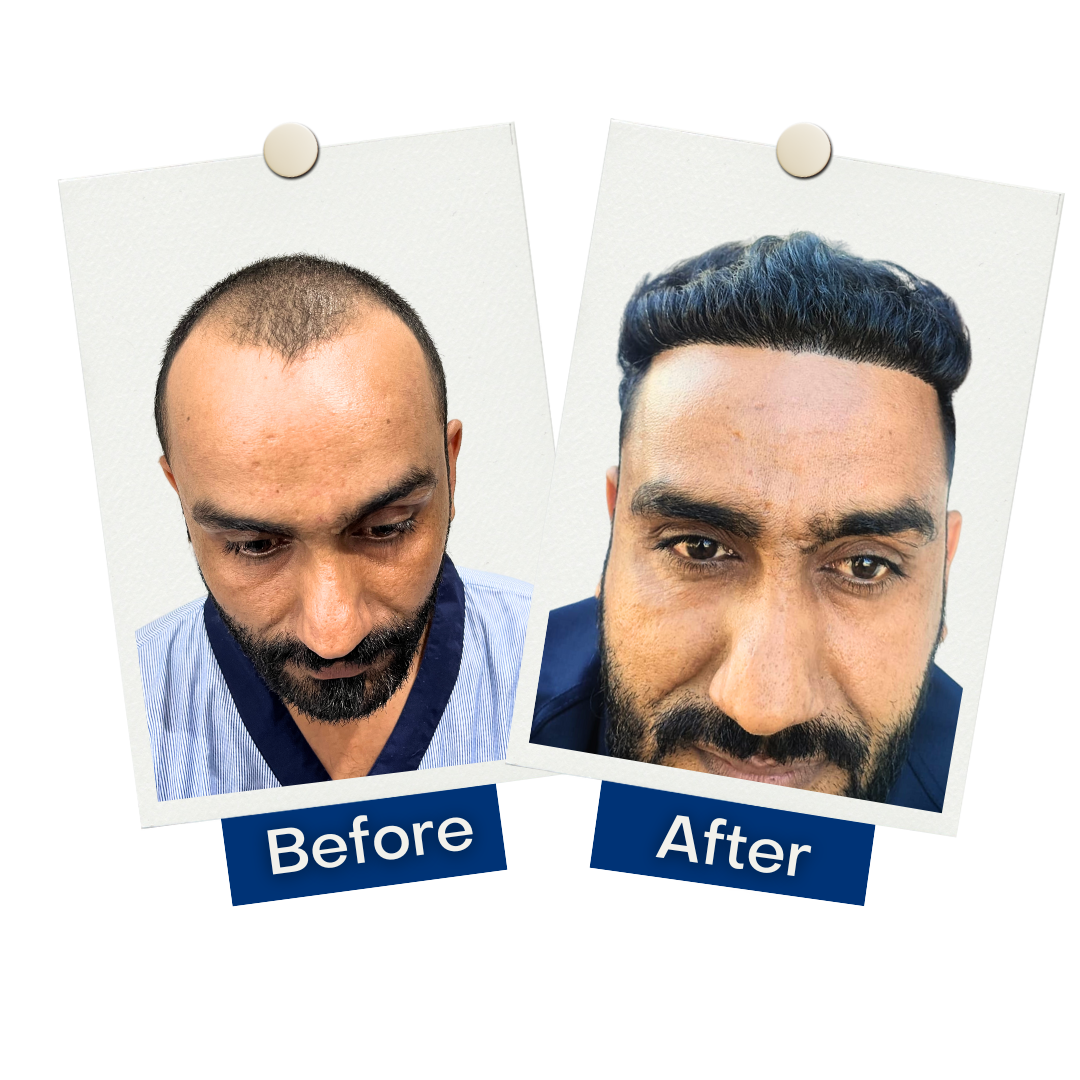 Hair Mate Clinic Hair Transplant Clinic Hair Transplantation at