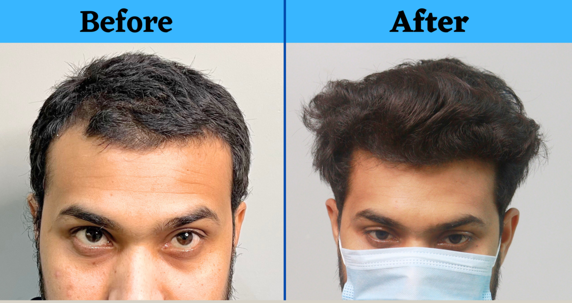 Hairmate Clinic Hair Transplant Clinic In India Hairmate Delhi