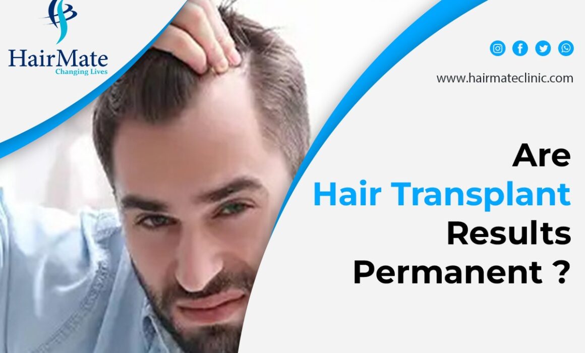 Are Hair Transplant Results Permanent?