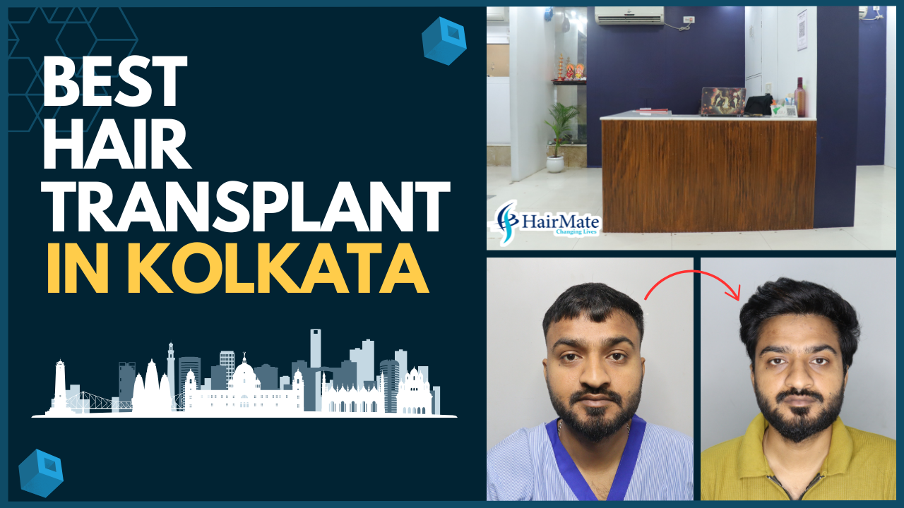 Best Hair Transplant In Kolkata