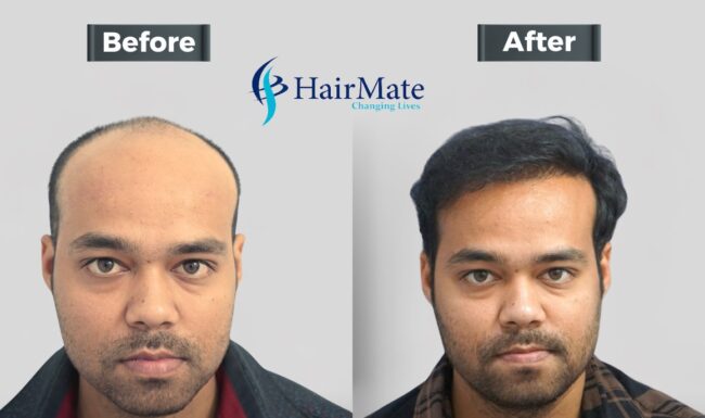 Hair Transplant Cost