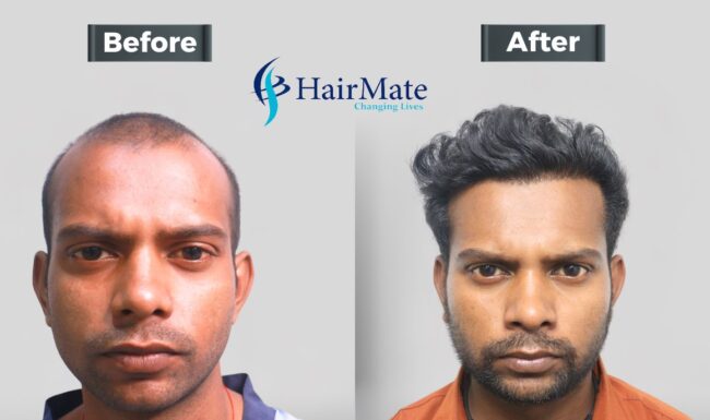 Hair Transplant In Delhi