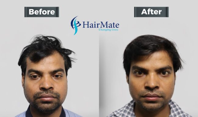 Hair Transplant In Kolkata