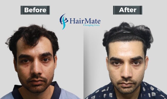 hair transplant in Pune