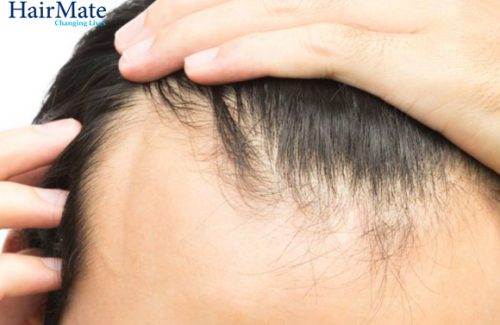 Receding Hairline